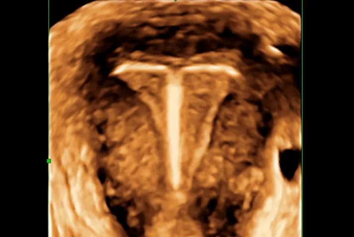 Przesunięcie wkładki domacicznej objawy – co powinno Cię zaniepokoić?