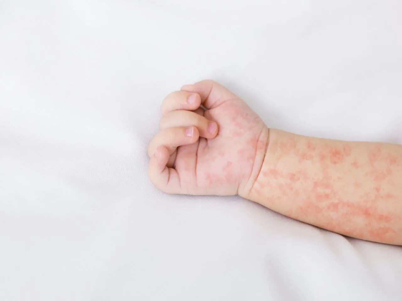 Jak wygląda alergia u niemowlaka? Objawy, które musisz znać