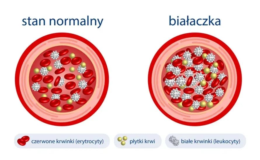 Objawy białaczki u niemowlaka - jak je rozpoznać i kiedy działać